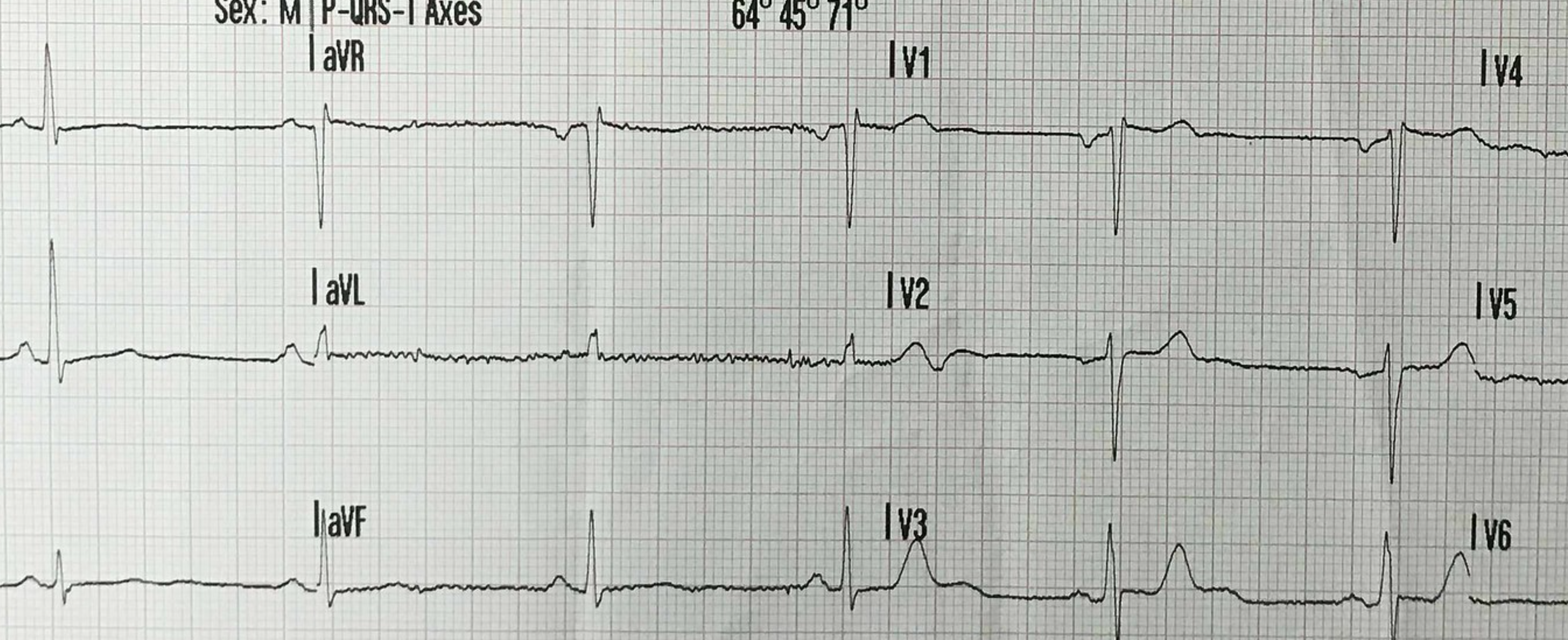 ECG Normal: Guia Completo de Critérios e Valores de Referência | Kraemer Academy (qtc.mocha.app)